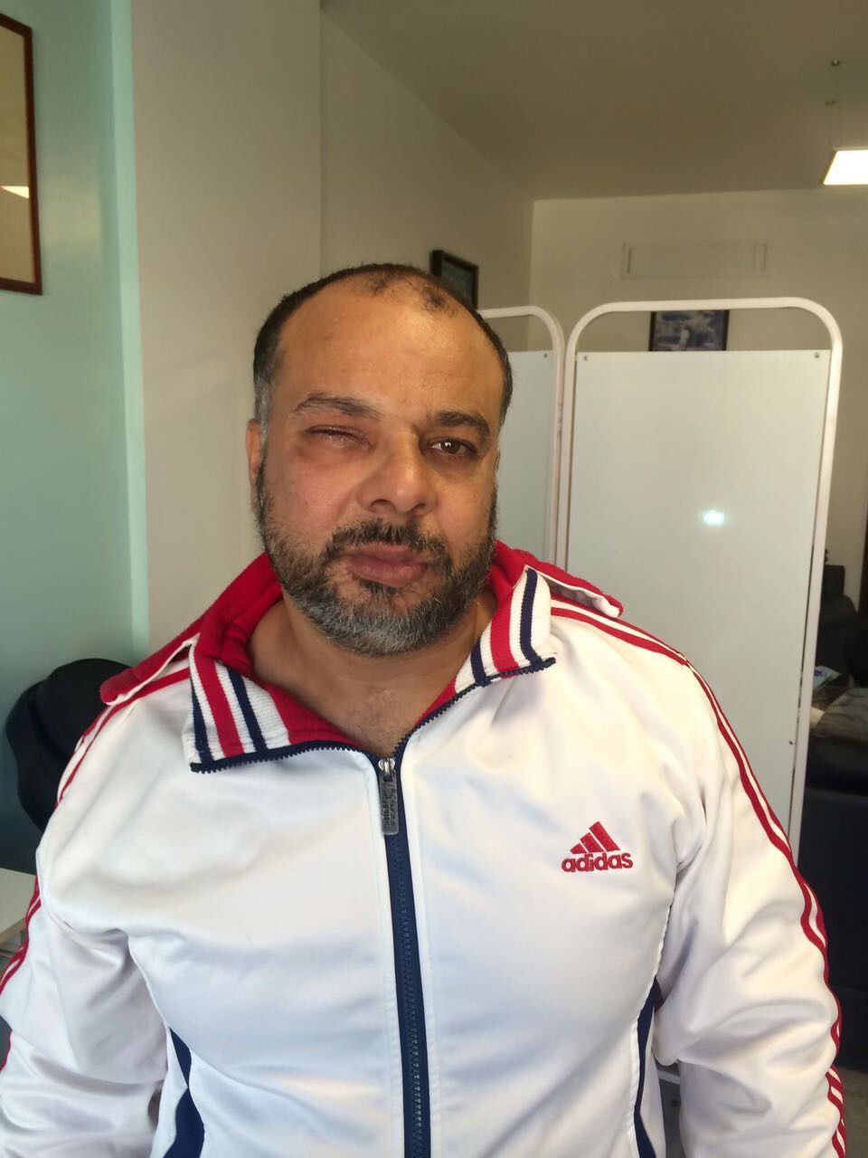 العين الإصطناعية ثلاثية الأبعاد المصنوعة من مادة resine synthetic ومهارة الأخصائي سامر كحيل في المركز اللبناني السويسري